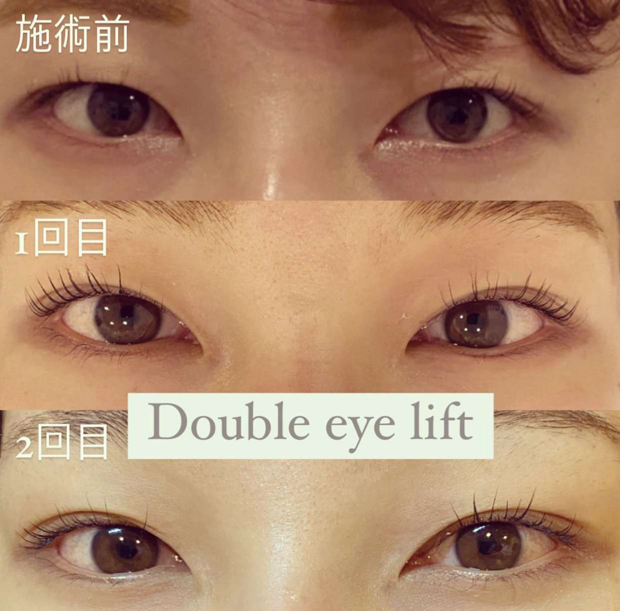 ダブルアイリフト